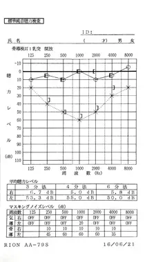 血液循環の悪化が原因で、中音域の左聴力が低下した左耳突発性難聴｜治療前のオージオグラム