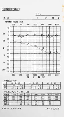 鍼治療で聴力が回復したウイルス感染が原因の左耳突発性難聴｜治療後のオージオグラム