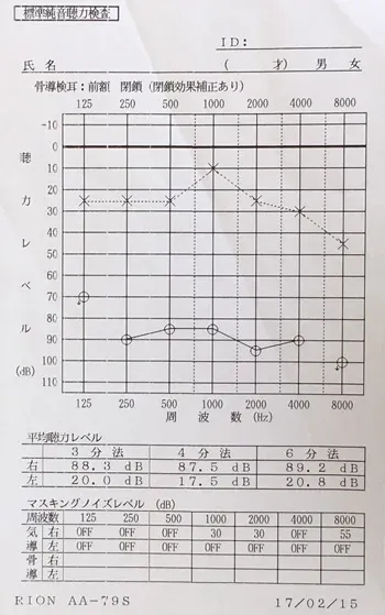 鍼治療前の突発性難聴