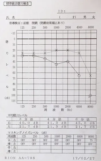 鍼治療でよくなった突発性難聴