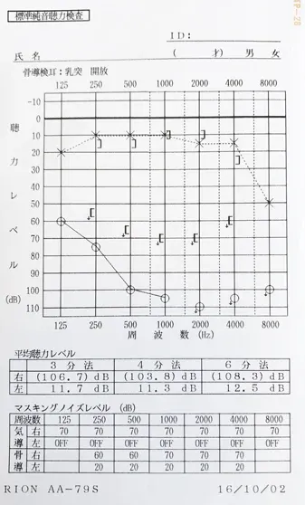 聴力が低下した外リンパ瘻 患者さんのオージオグラム 治療前