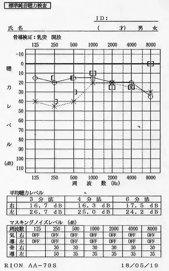 オージオグラム【治療前】