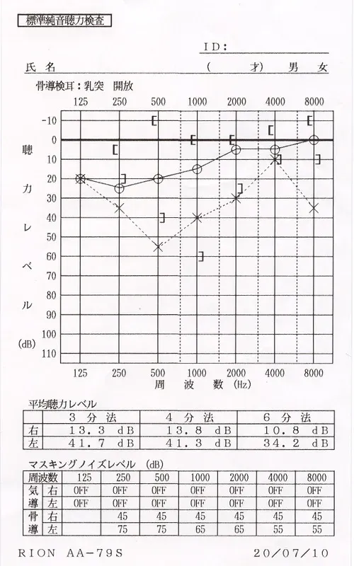 鍼治療3カ月後のオージオグラム