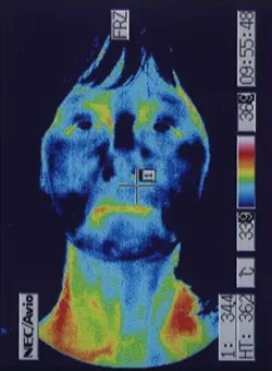 ストレスで顔の温度が低下したサーモグラフィ画像：治療前