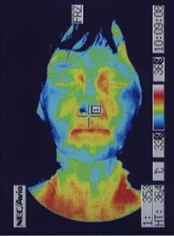 顔の温度が回復したサーモグラフィ画像：鍼治療後