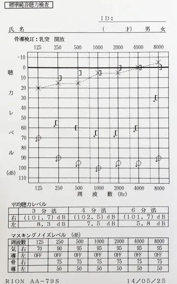 ムンプス難聴で右耳スケールアウトのオージオグラム|小学4年生時