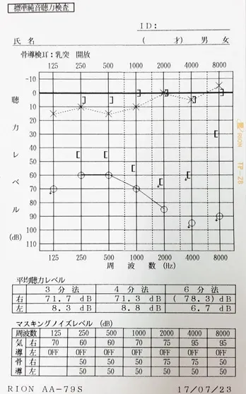 鍼治療で右耳スケールアウトが改善したオージオグラム|中学1年生時