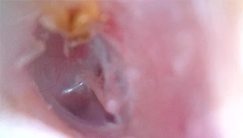 穴が開いた鼓膜|レーザー治療から4週間