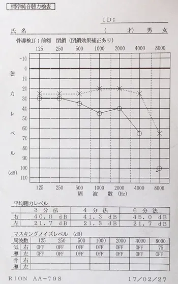 鍼治療後の聴力が回復した状態のオージオグラム