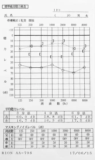 ラムゼイハント症候群｜鍼治療と音響療法で聴力が改善したオージオグラム