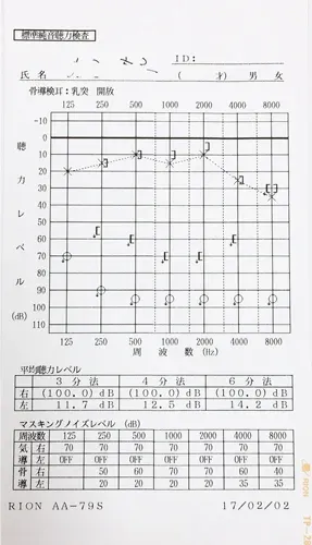 聴力が低下している心因性難聴のオージオグラム
