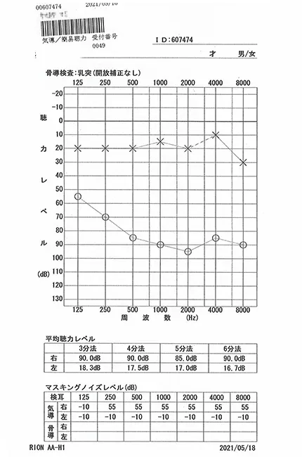 片耳が全く聞こえない突発性難聴｜オージオグラム（治療後）