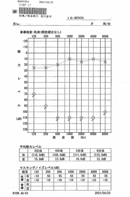 片耳が全く聞こえない突発性難聴｜オージオグラム（治療前）