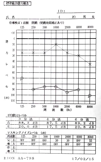 右耳の聴力が低下したオージオグラム：治療前