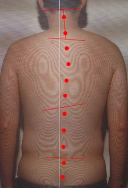 聴覚補充現象 体の歪み 治療後