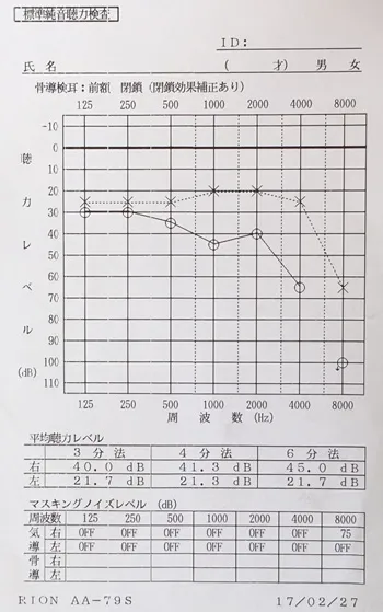 聴覚補充現象　治療後のオージオグラム