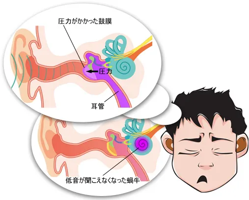 鼓膜に圧力がかかり低音が聞こえなくなった蝸牛/内耳の障害で低音が聴こえなくなった蝸牛