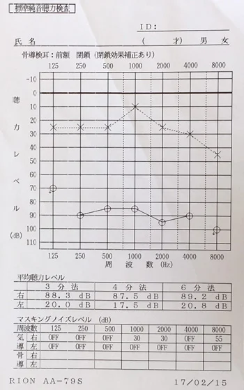 オージオグラム：突発性難聴治療前