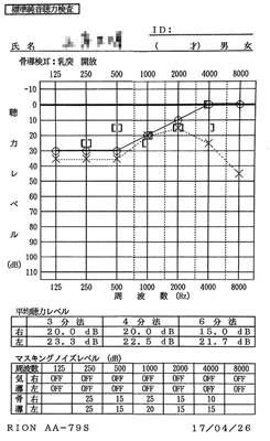 突発性難聴 発症後6カ月経過｜低音が正常値(耳鼻科的には30㏈)まで回復したオージオグラム（鍼治療後）