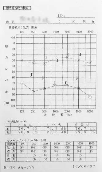 ラムゼイハント症候群｜鍼治療前の聴力が低下しているオージオグラム