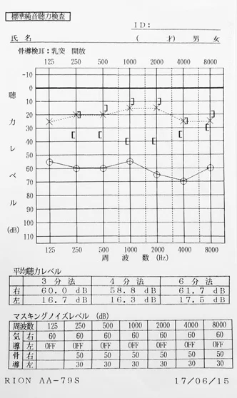 ラムゼイハント症候群｜鍼治療と音響療法で聴力が改善したオージオグラム