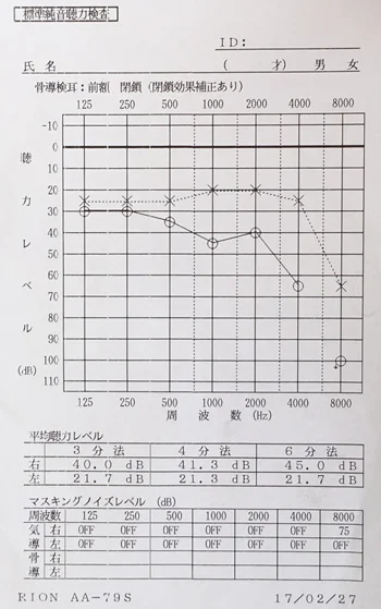 鍼治療でよくなった突発性難聴