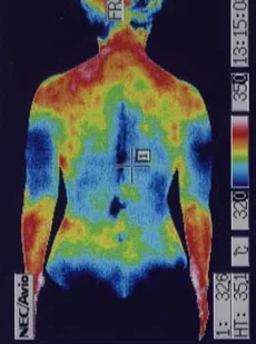 鍼治療で体温が上がった腰周囲の温度