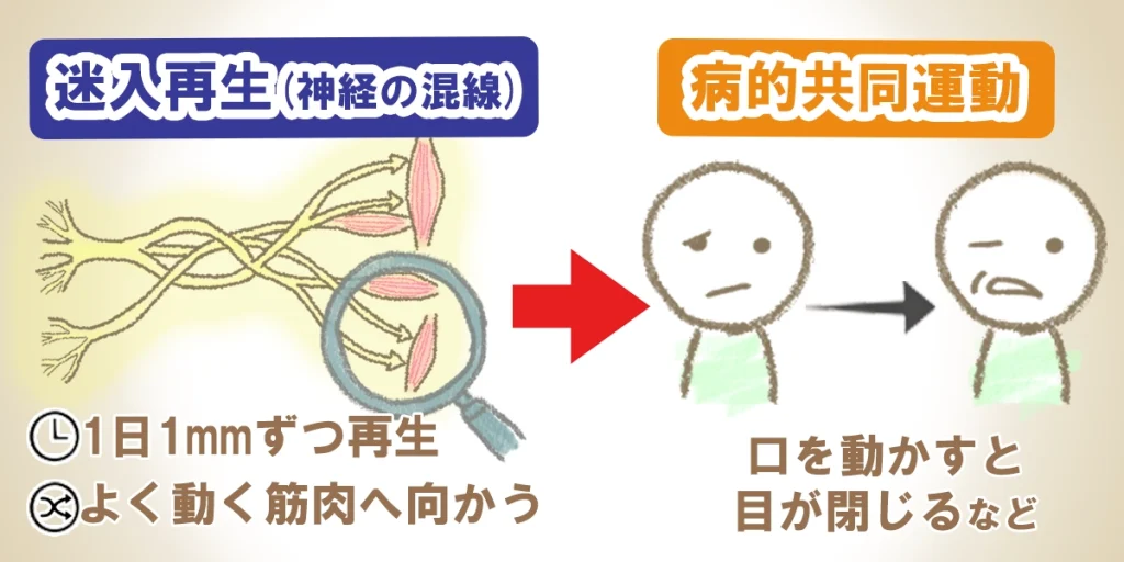 迷入再生(神経の混線)してしまうことで起こる病的共同運動を図解