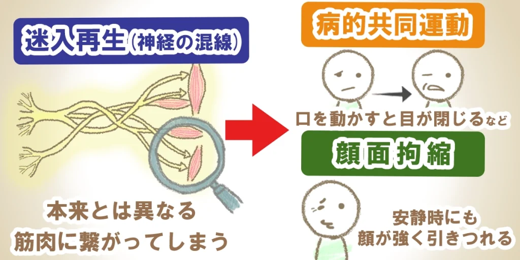 手術後、迷入再生(神経の混線)によって生じる「病的共同運動」と「顔面拘縮」の図解